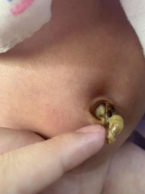 สะดือปกติไหมคะ