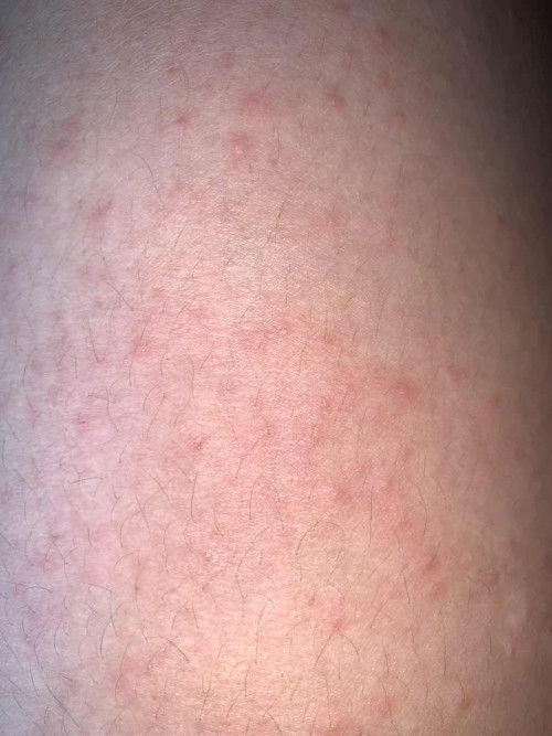 Gatal gatal saat hamil TM 3