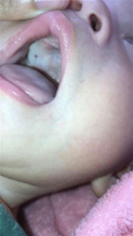 จุดแดงๆในเหงือก