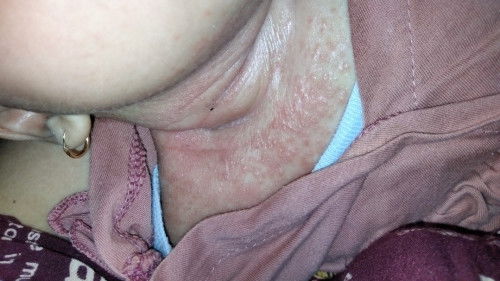 Biang keringat di leher