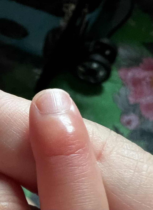 Jari tangan bayi bengkak