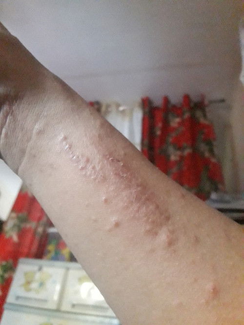 Mga mi 37weeks and  2days na ako worry lng nitong 3rd trimester tinubuan ako ng mga rashes makati...