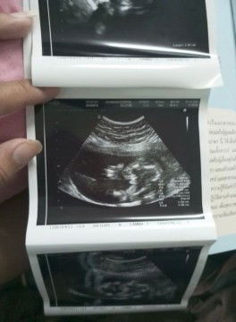 ผช.ใช่ไหมคะแบบนี้หมอบอกผช.