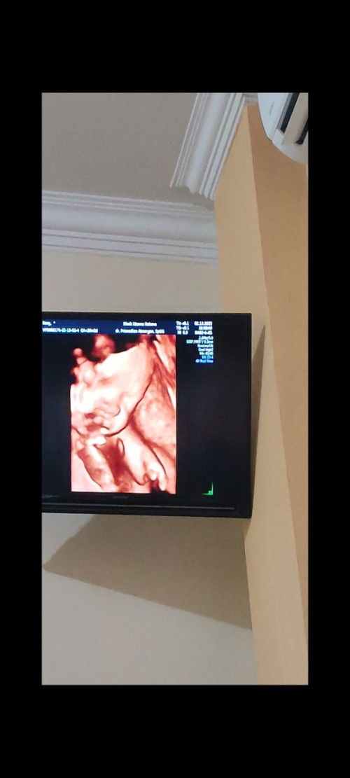 Hasil usg tangan janin