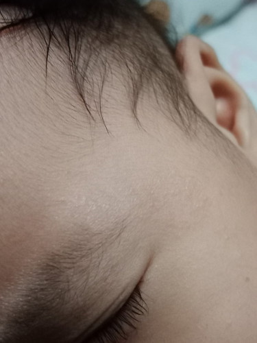 Rashes?ni baby simula newborn