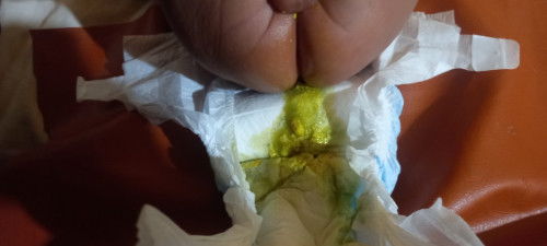 Apa tanda diare bayi usia 1 bulan?