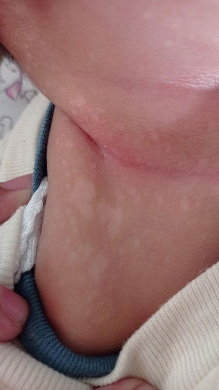 Ruam dan bercak putib