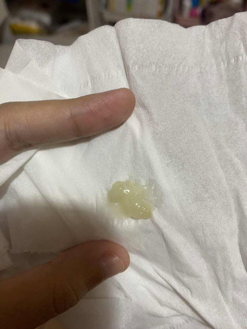 Mucus plug atau keputihan?