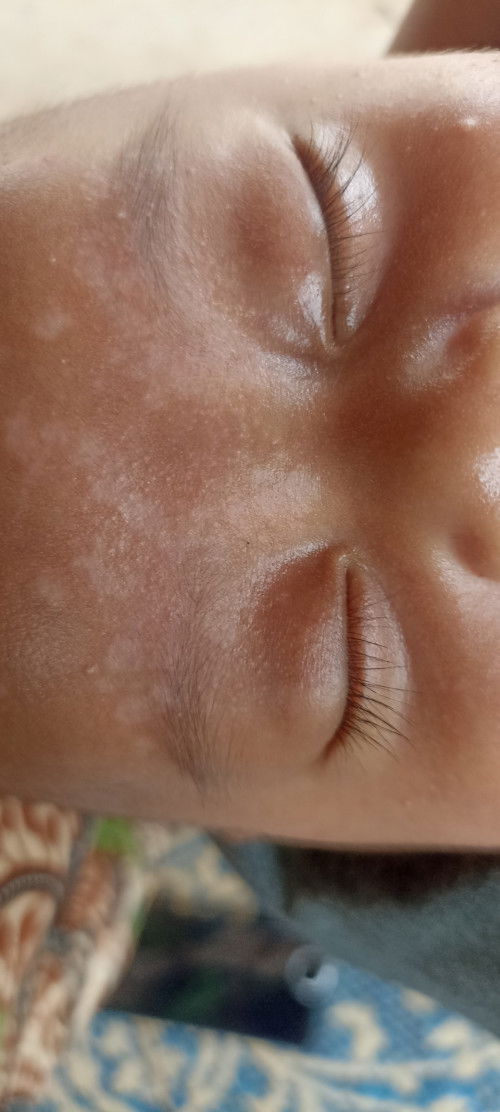 Bercak putih seperti panu