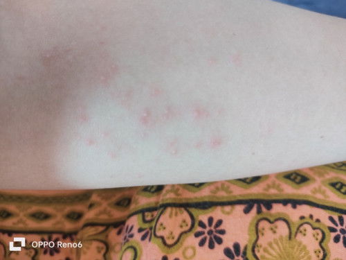 Penyebab bintik merah saat hamil ?