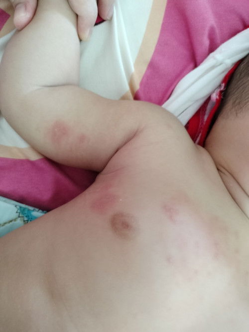 แผลจากแมลง