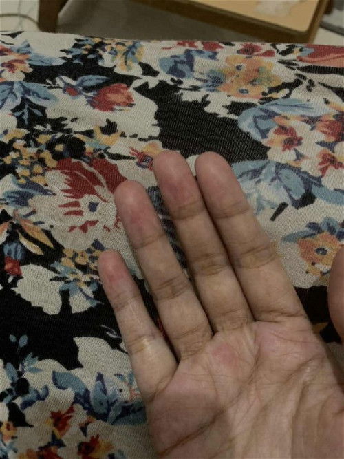 Rasa Kesemutan di ujung2 jari tangan 18w