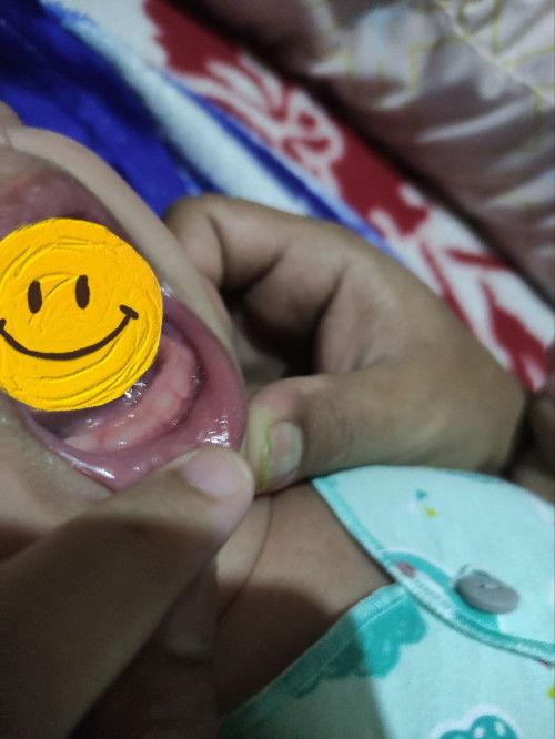 Apakah Ini Tanda Tumbuh Gigi?