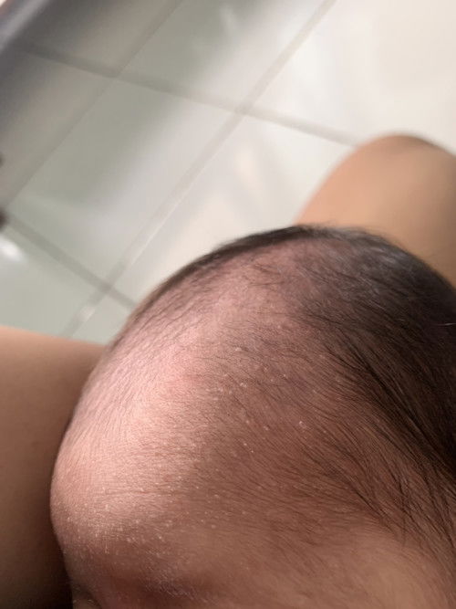 Bruntusan di newborn