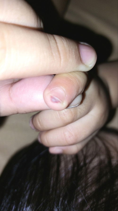 Naipit ung daliri ng baby ko namuo yung dugo 🥺😭