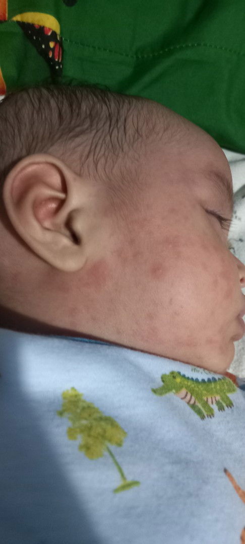 Bintik merah pada bayi