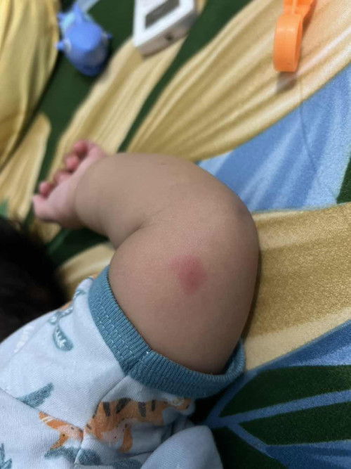 Merah merah di kulit