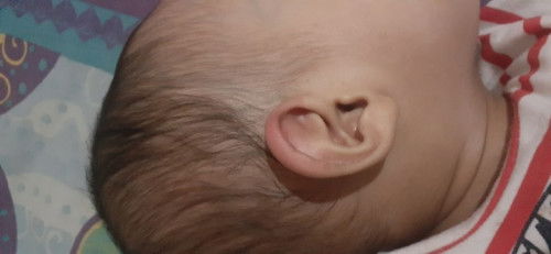 Bun,daun telinga anak saya tiba" merah dan bengkak..tp tdk ada bekas gigitan?knp ya bun?