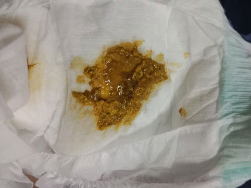 อยากทราบว่าน้องถ่ายแบบนี้ปกติไหมค่ะ ส่วนมากน้องจะทานนมผงเป็นหลักค่ะ