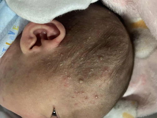 ผื่นหนองแบบนี้เกิดจากอะไร