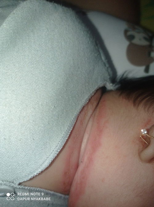 Ruam/Eksim di leher dan pantat