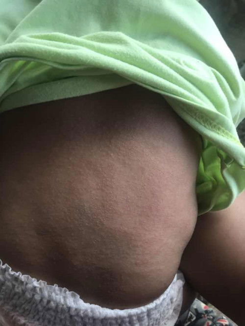 ลูกขึ้นผื่น ทำไงขอคำแนะนำทีค่ะ