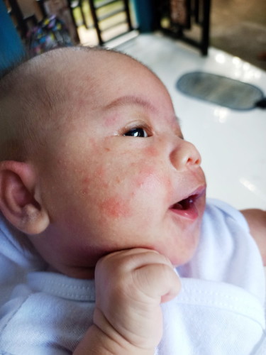 RASHES SA BABY