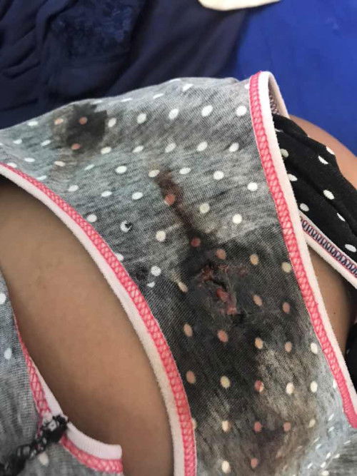 Dumugo after mag I.E normal
lng ba?