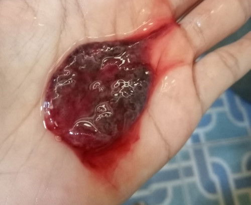 Keguguran hamil muda