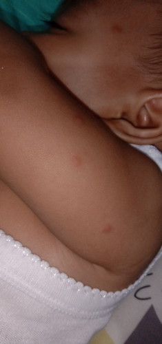 Bayi mpasi keluar bintik bintik seperti ini apakah tanda alergi makanan atau digigit nyamuk/semut ya