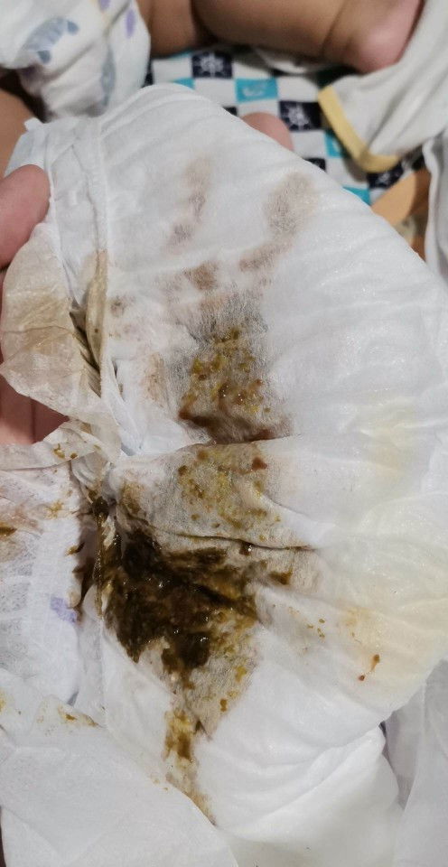 Normal po ba ito once magtake ng antibiotic si baby?