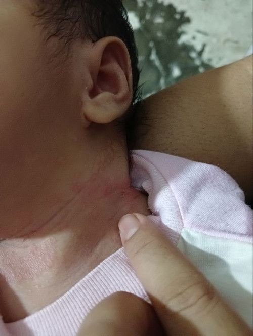 Ruam kemarahan diarea leher