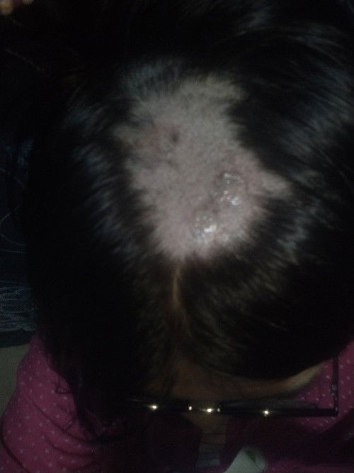 Kulit kepala luka berair dan sulit kering