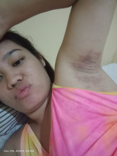 Rashes sa kili kili