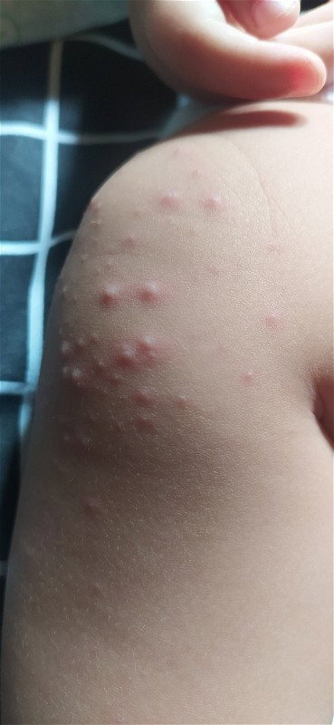 Muncul bintik merah di kaki anak setelah sakit panas