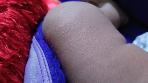 Bruntusan tapi kecil banget seperti pori pori membesar