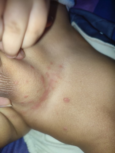 Selangkangan bayi bintik2