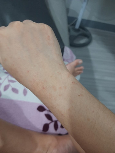 Remedies for rashes, sobrang kati po at di na ako pinapatulog sa gabi.