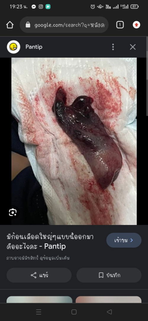 มีก้อนเนื้ออกจากช่องคลอด