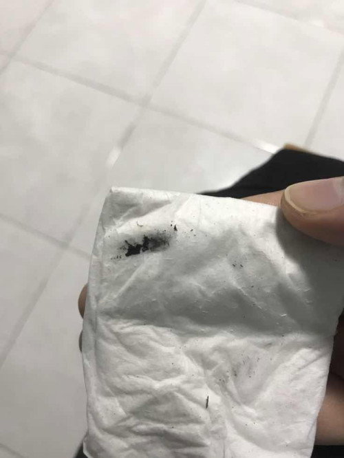 Serpihan hitam dalam air kencing