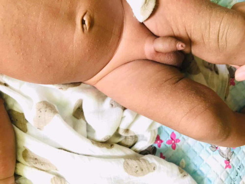 คุณแม่บ้านไหนลูกมีผด ผื่น มีเม็ดขาวๆขึ้นแบบนี้บ้างคะ อันตรายมั้ย