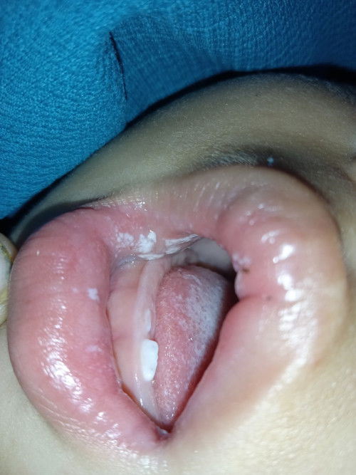 Sariawan di sekitar Area Mulut Anak