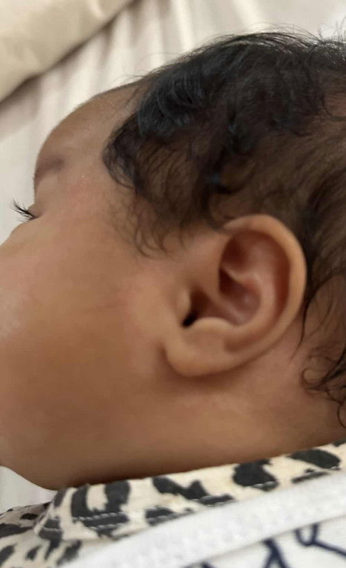 Tompok2 putih pada muka