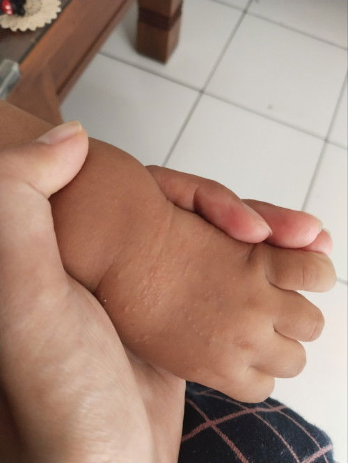 Bintik bintik kecil pada anak 2 thn