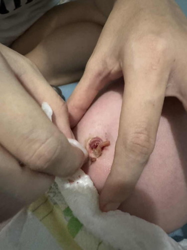 Baby’s umbilical cord fell off while changing. What do i do?