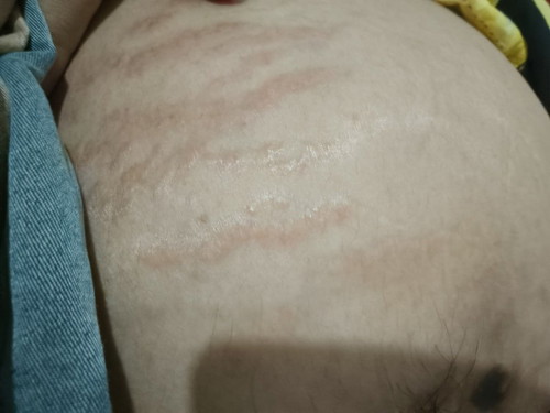 Stretch marks?