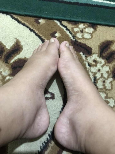 Kaki bengkak sudah semingguan belum kempes tapi tensi normal ngga tinggi kata orang ini mau lahiran