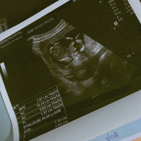 อัลตร้าซาวด์ ครั้งแรก