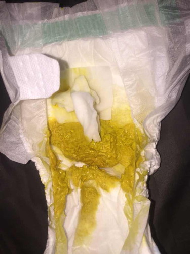 ลักษณะอึของลูก