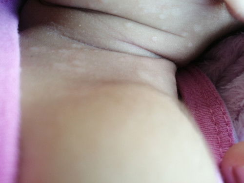 Sino po dto nkaexperience ng ganito sa baby. Nakita ko kasi sa leeg ni baby. Ano kaya gamot nito.?